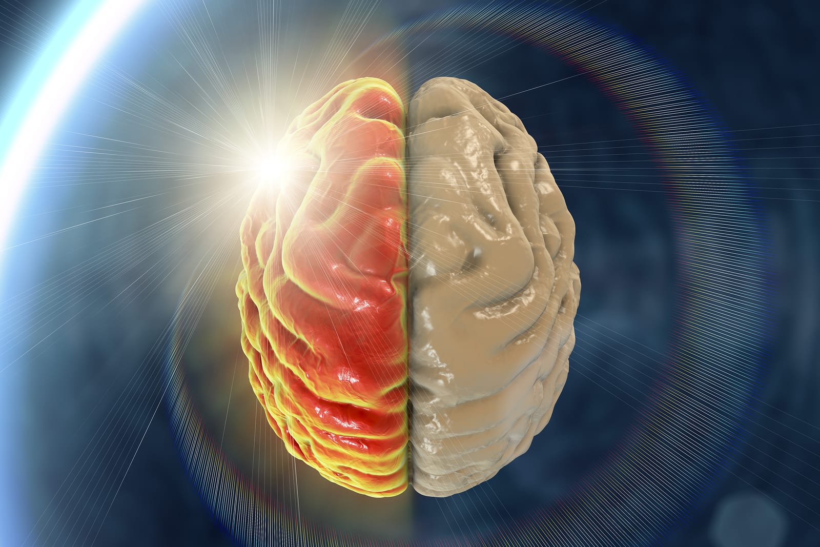 Migraine, hemicrania, medical concept showing pain in half of brain and migraine aura, 3D illustration